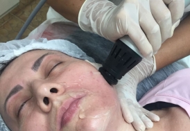 tratamento de flacidez facial